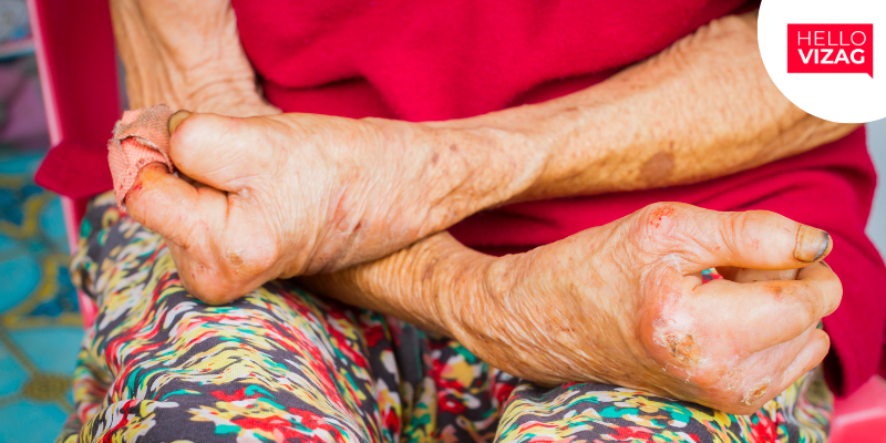 Leprosy-Linked Disabilities in Visakhapatnam Surpass National Average, Study Reveals